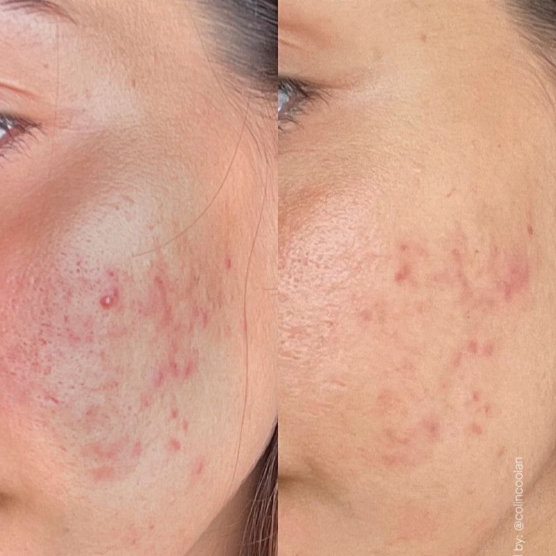 Azid 15% Azelaic Acid